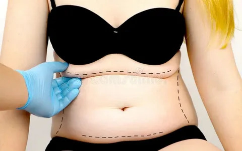 liposuction breast fat transfer